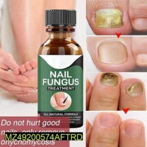 Fast Nail Fungal Treatments Nail Repair